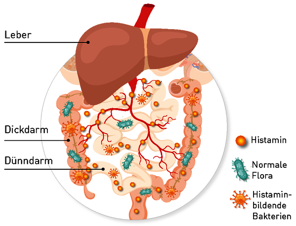 3 Ursachen eines herhöhten Histaminspiegels im Blut